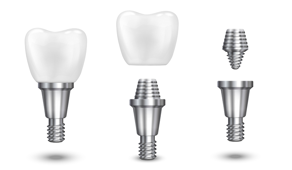 Dental Implants in Whittier