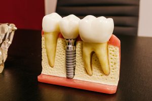 Implants Dentist in Whittier, CA