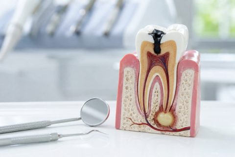 Dental model showing a tooth abscess with dental tools in a clean clinical setting