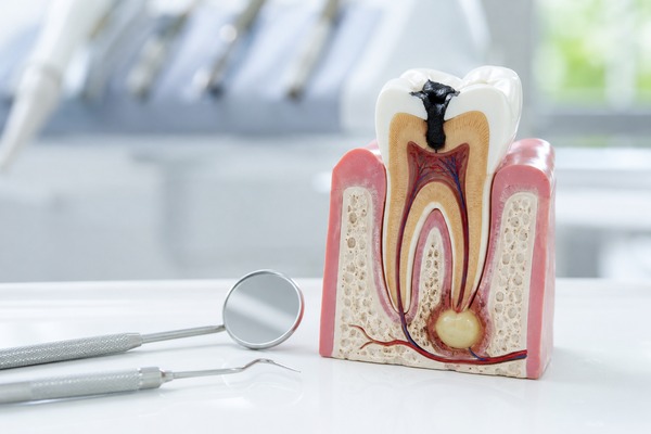 Can A Dental Abscess Go Away On Its Own?