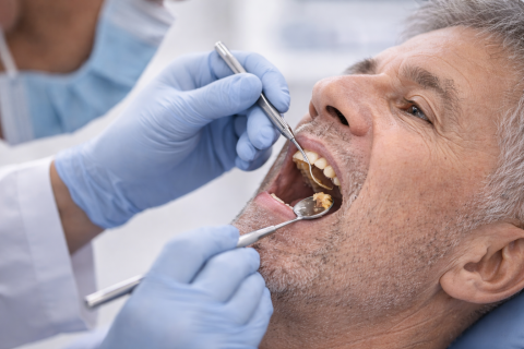 Food stuck between teeth causing discomfort during dental exam in Whittier CA