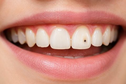 Black spot on tooth cavity in Whittier CA