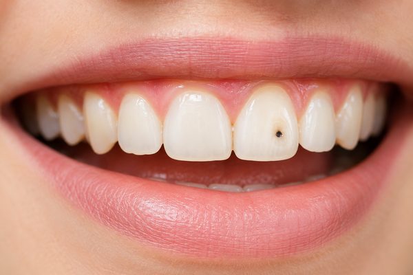 Black spot on tooth cavity in Whittier CA